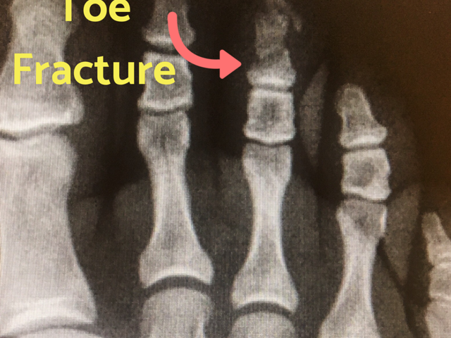 cracked toe bone